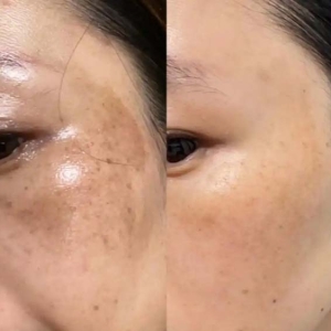 韩国皮肤科 Revlite SI 焕肤成新宠，韩国医美技术破解色素难题