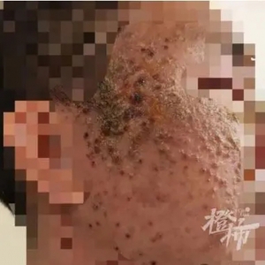 30天不洗脸皮肤会更好？杭州一男子试了一个月，脸皮变“树皮”
